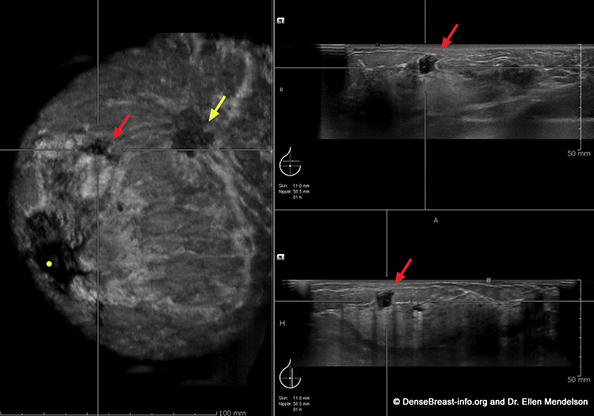 invasive ductal carcinoma ultrasound