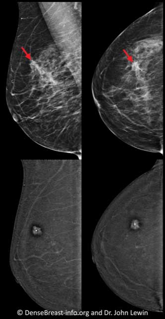 Black: high density of contrast medium. White: low density of contrast