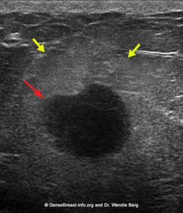 Ultrasound of Triple Negative Breast Cancer