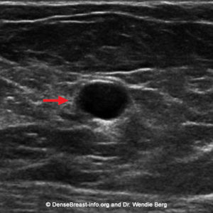 Ultrasound of a simple cyst