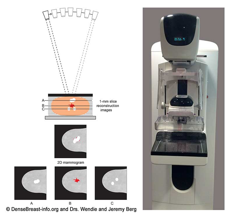 2D/3D Mammography, Density Assessment Software