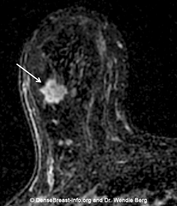 Breast MRI DenseBreastinfo, Inc.