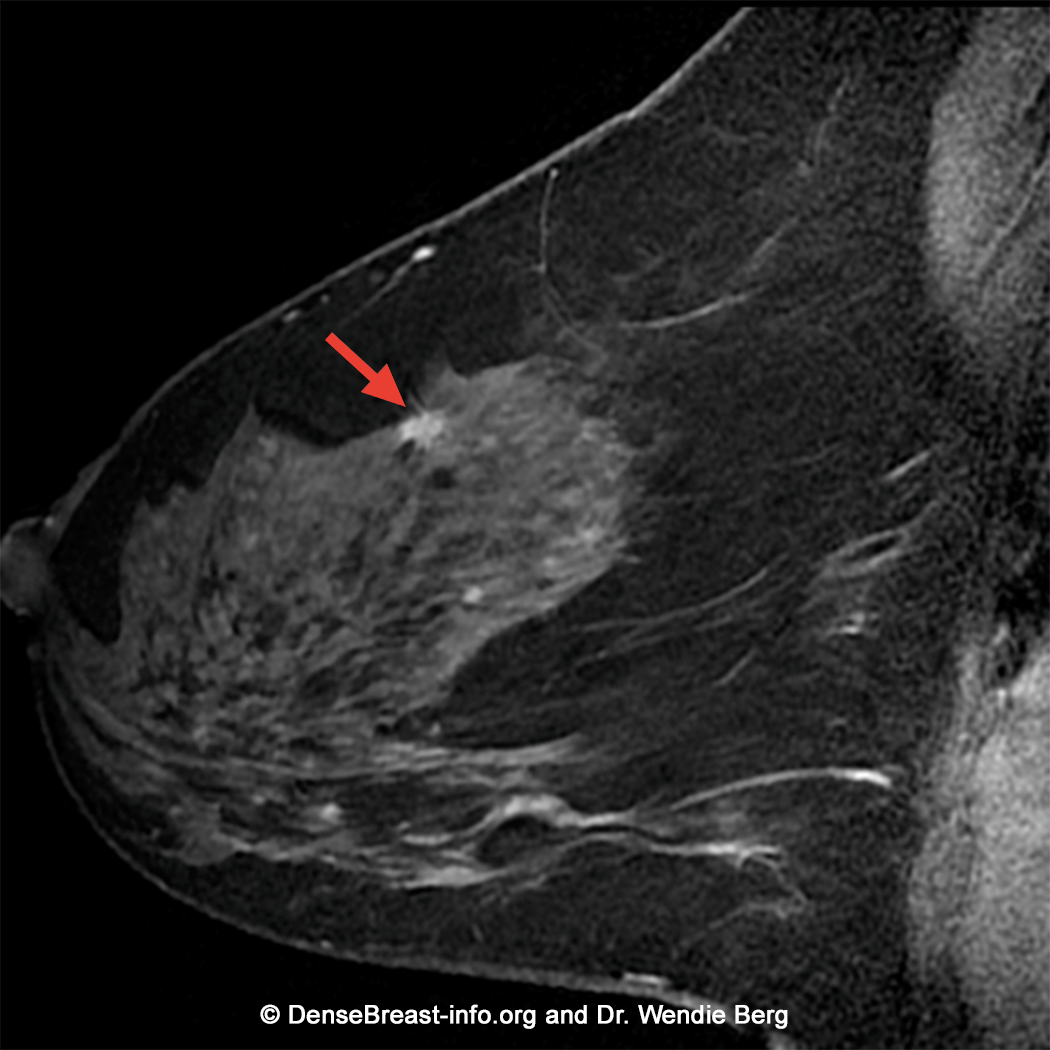 MRIs, contrast-enhanced mammography useful for small breast tumors
