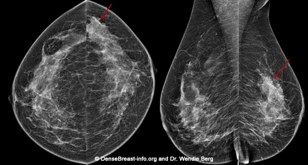 3D vs 2D mammography for detecting cancer in dense breasts