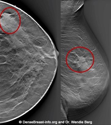 Mammogram images: Normal, abnormal, and breast cancer