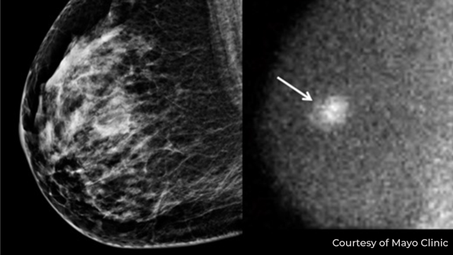 Molecular Breast Imaging | Dense Breast Info