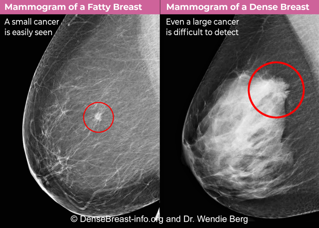 Comparison of a Dense Breast vs. a Fatty Breast