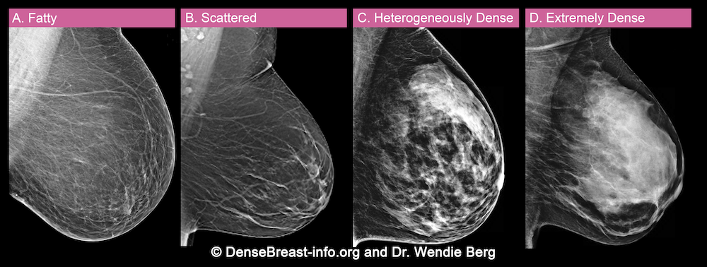 How is breast density determined?