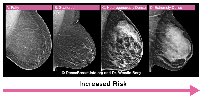 Dense breast tissue quiz  Ohio State Health & Discovery
