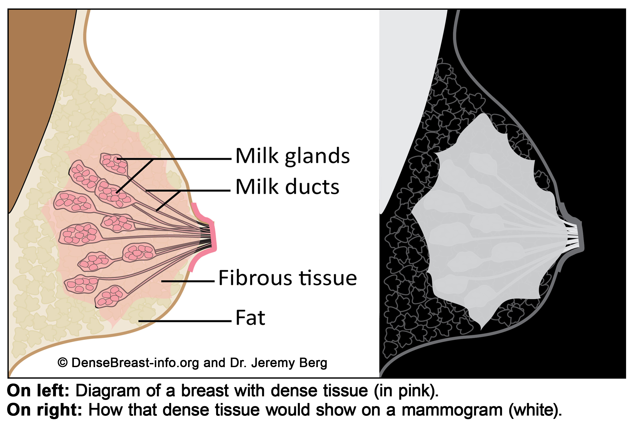 Dense Breasts: 5 Facts You Should Know