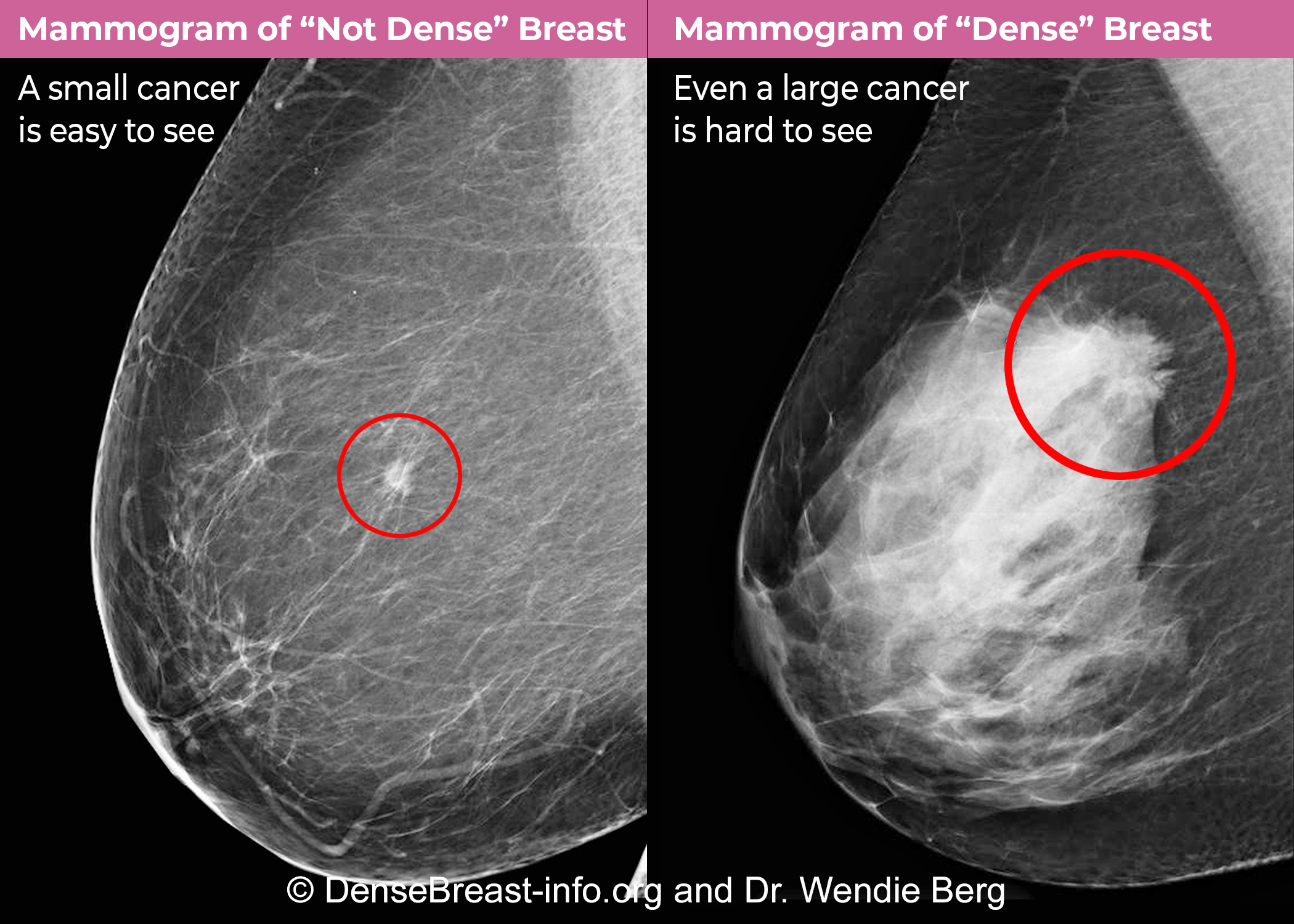 What is dense breast tissue? What are dense breasts?