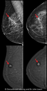 contrast enhanced mammographic images side by side