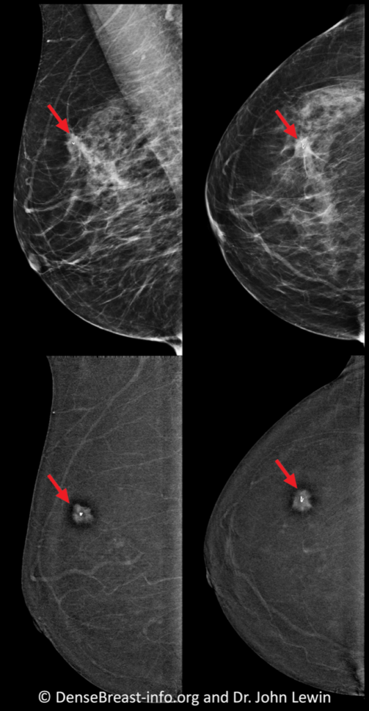 Contrast-Enhanced Mammography (CEM) | DenseBreast-info, Inc.