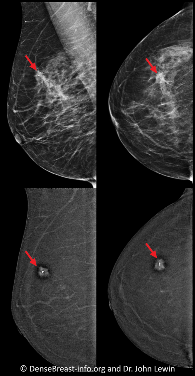 Contrast-Enhanced Mammography (CEM)