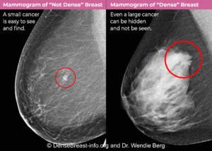 two comparative mammographic images